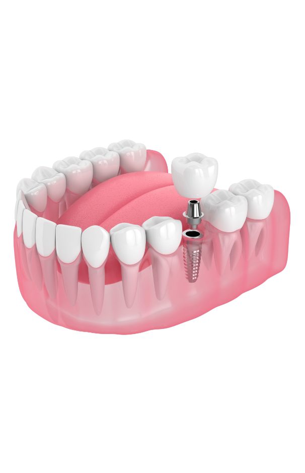 Dental Implants treatment