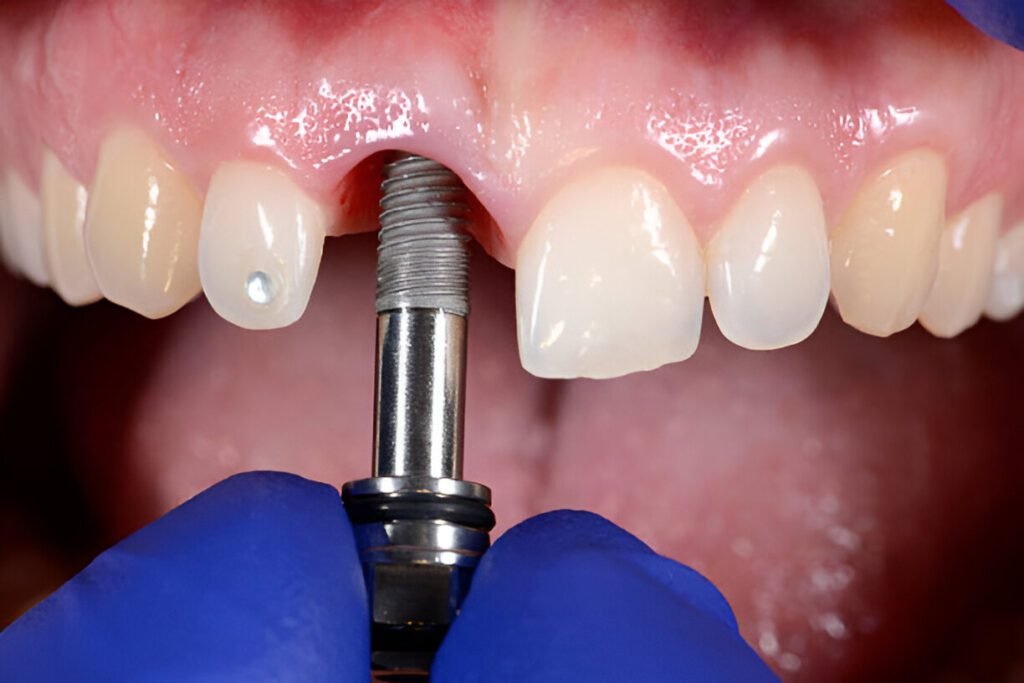 How Much Does a Single Dental Implant Cost in the UK?