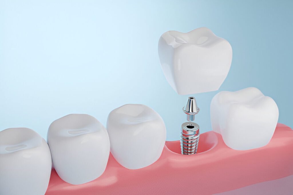 How Much Do Dental Implants Cost in Scotland?