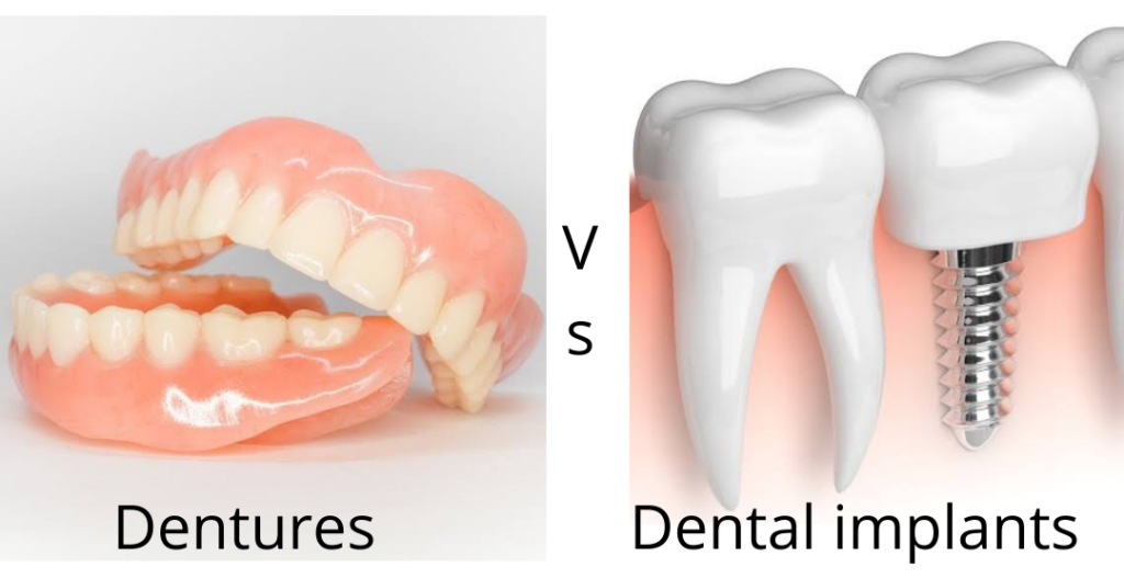 Dentures v/s Implants