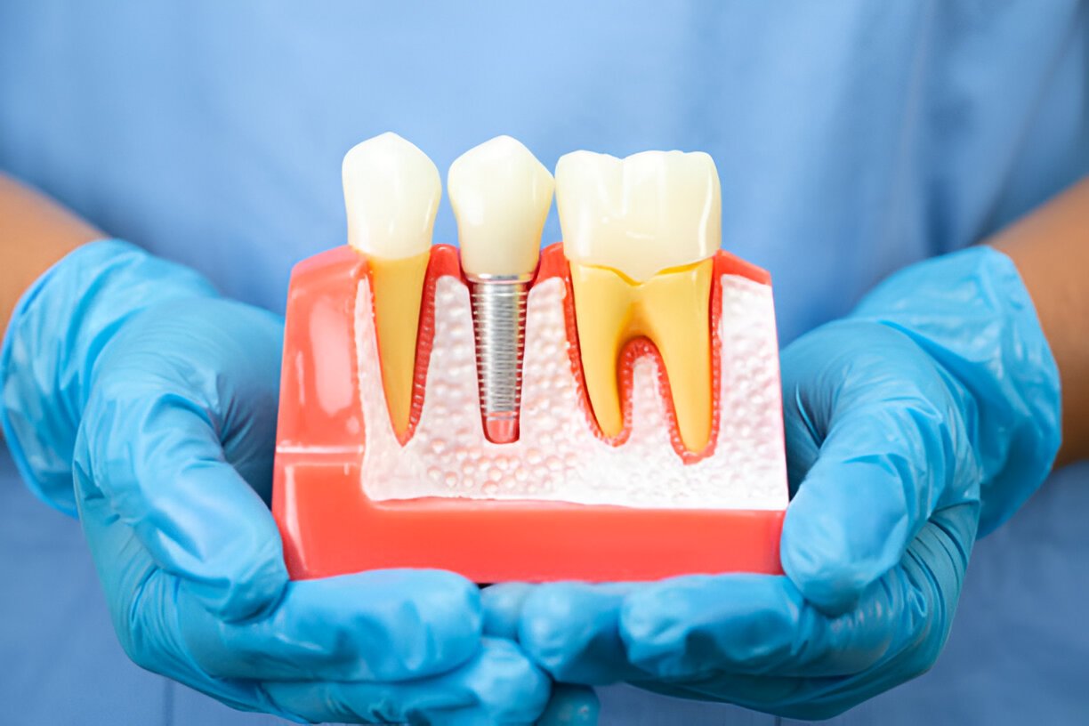 How Long Does a Single Tooth Implant Take