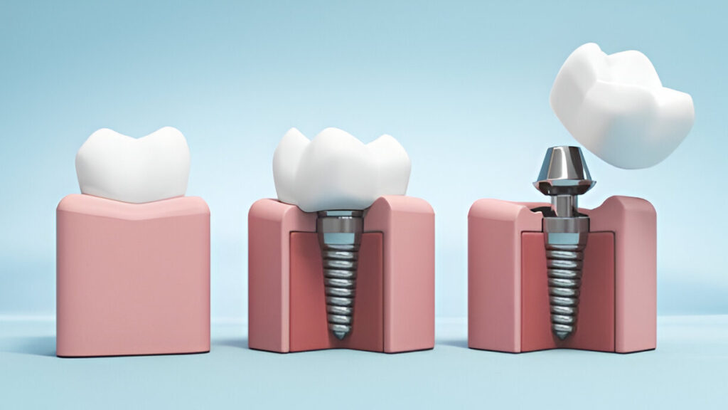 Dental Implants