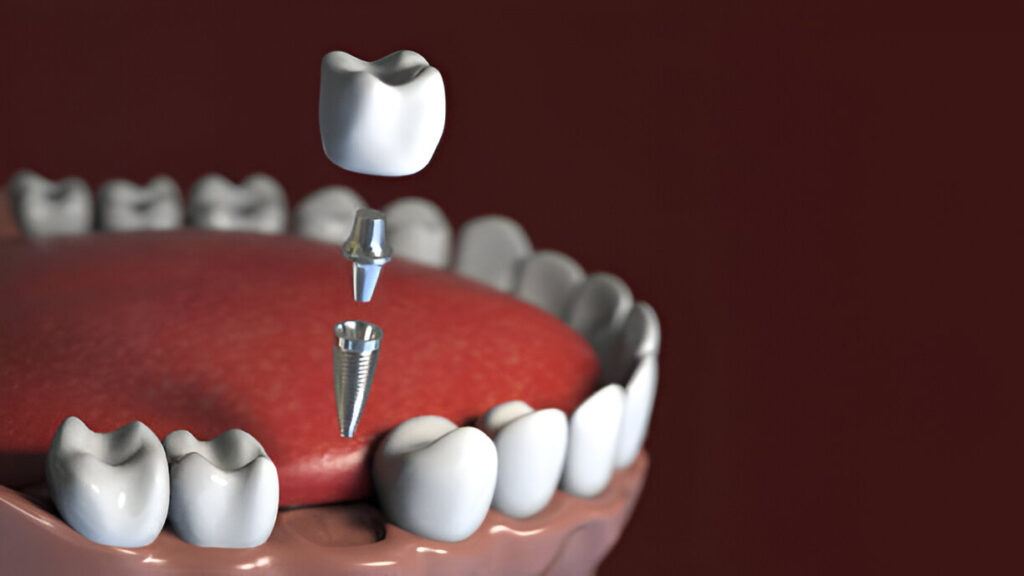 Dental Implant