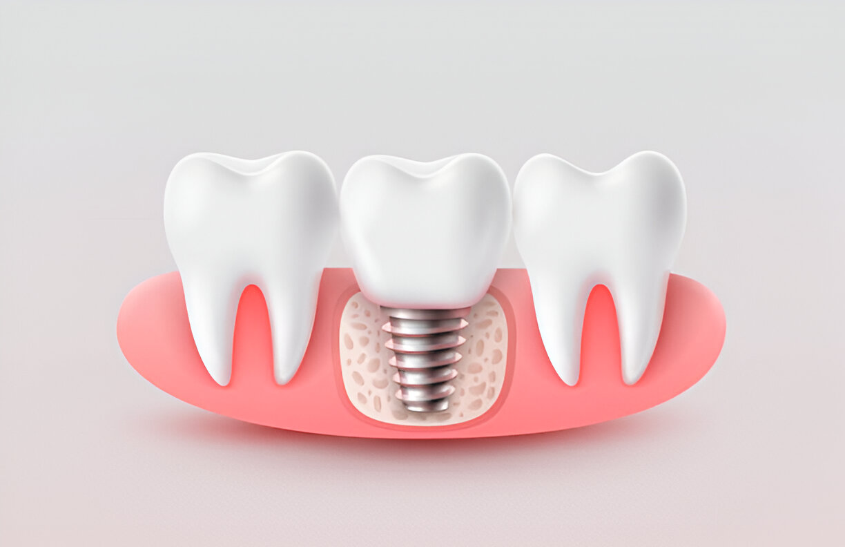 Dental Implants