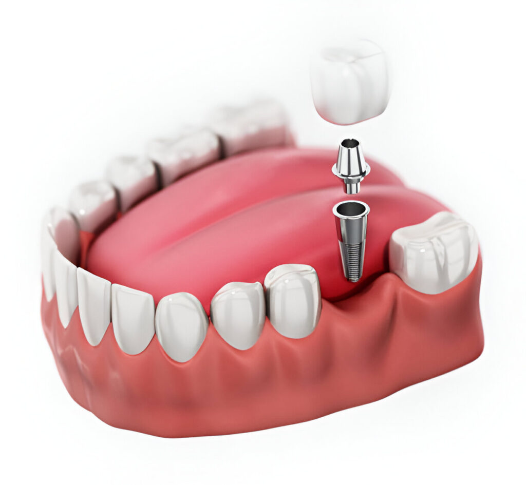 Dental Implants