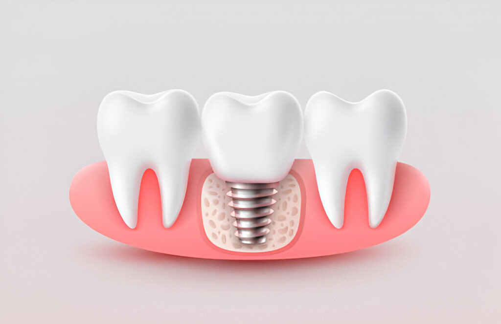 dental implant