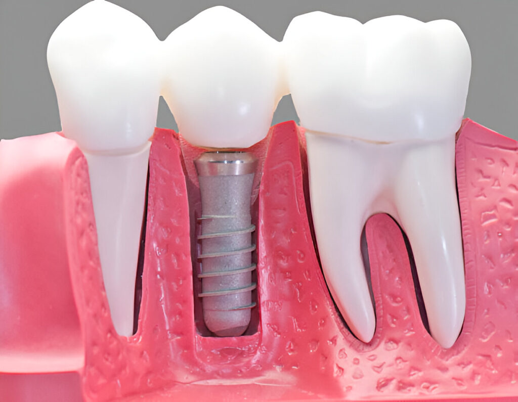 Dental Implants