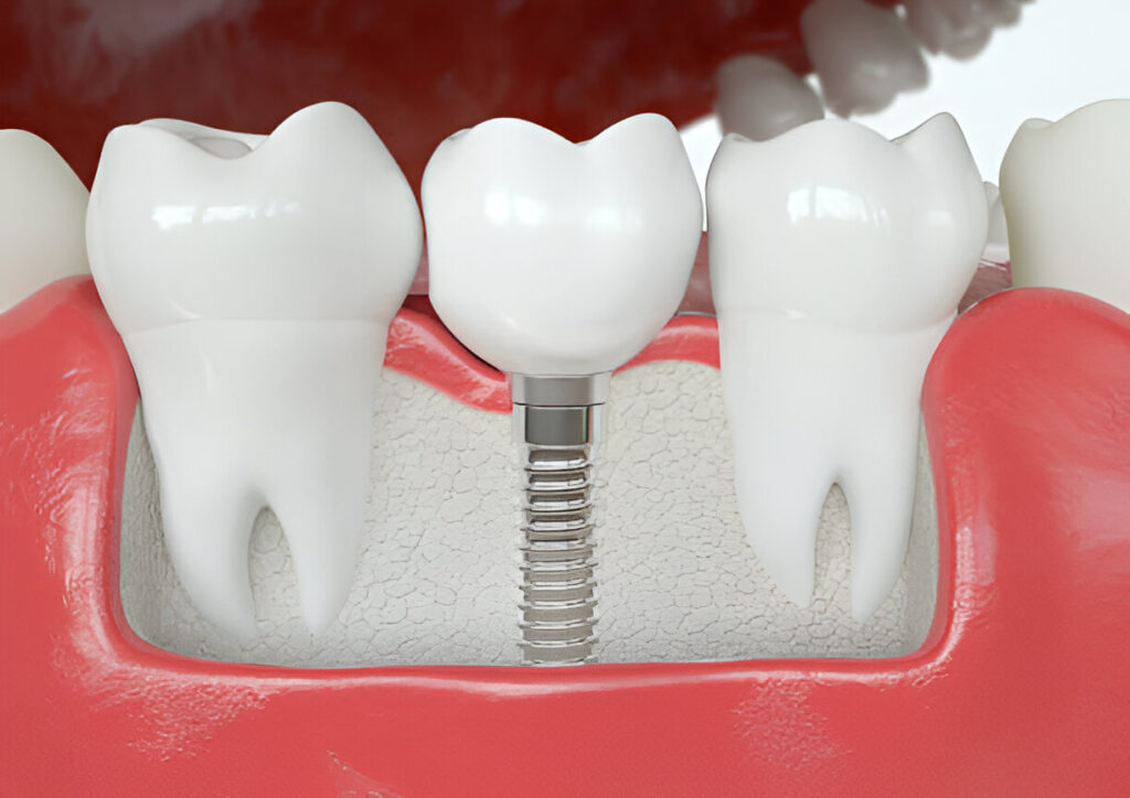 Dental Implants