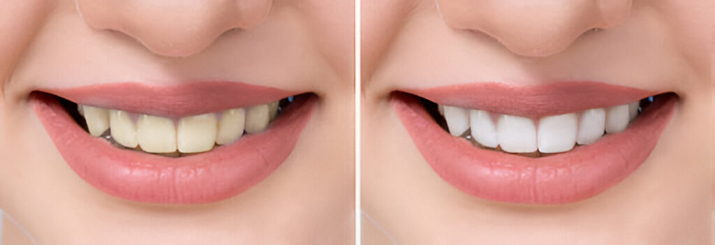 Teeth whitening