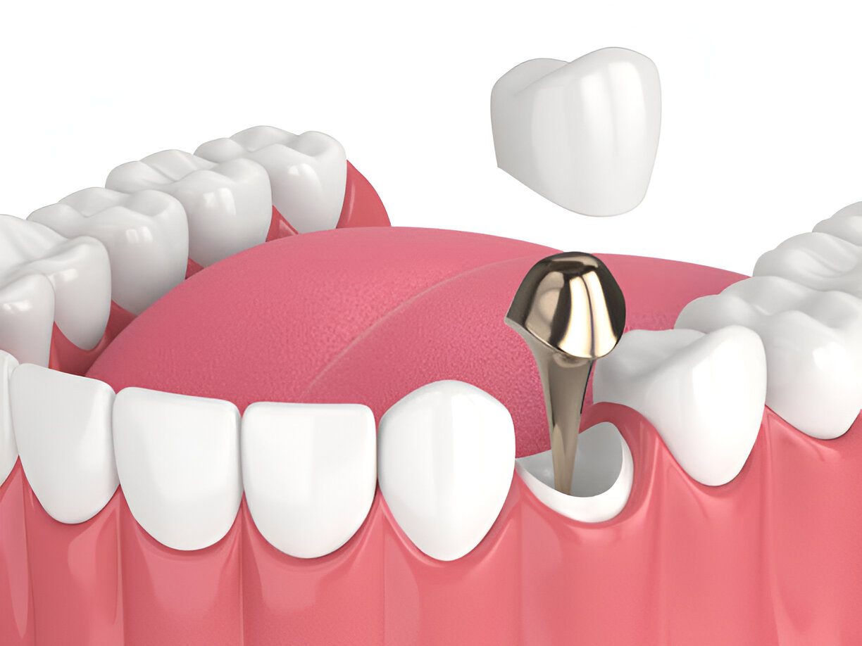 Dental Implant vs. Bridge