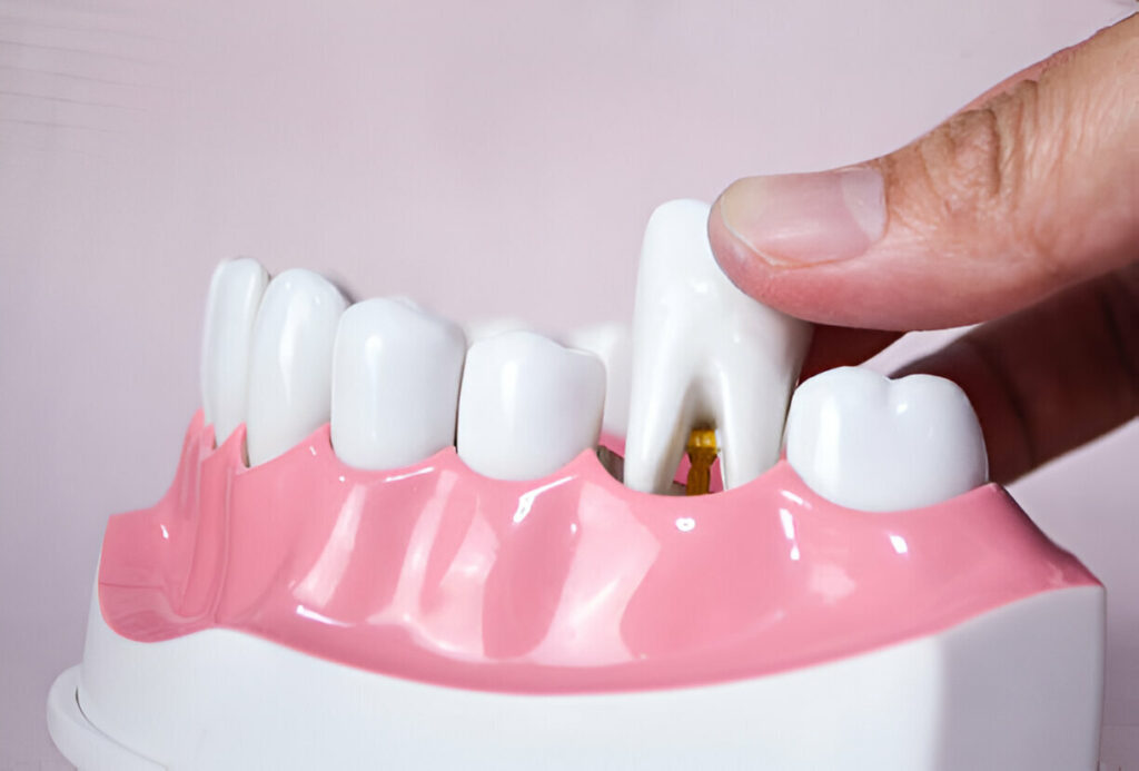Dentures Be Fitted to Receding