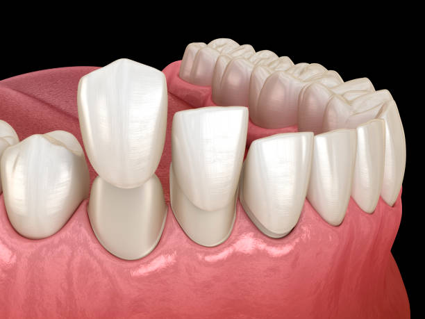 Composite Bonding