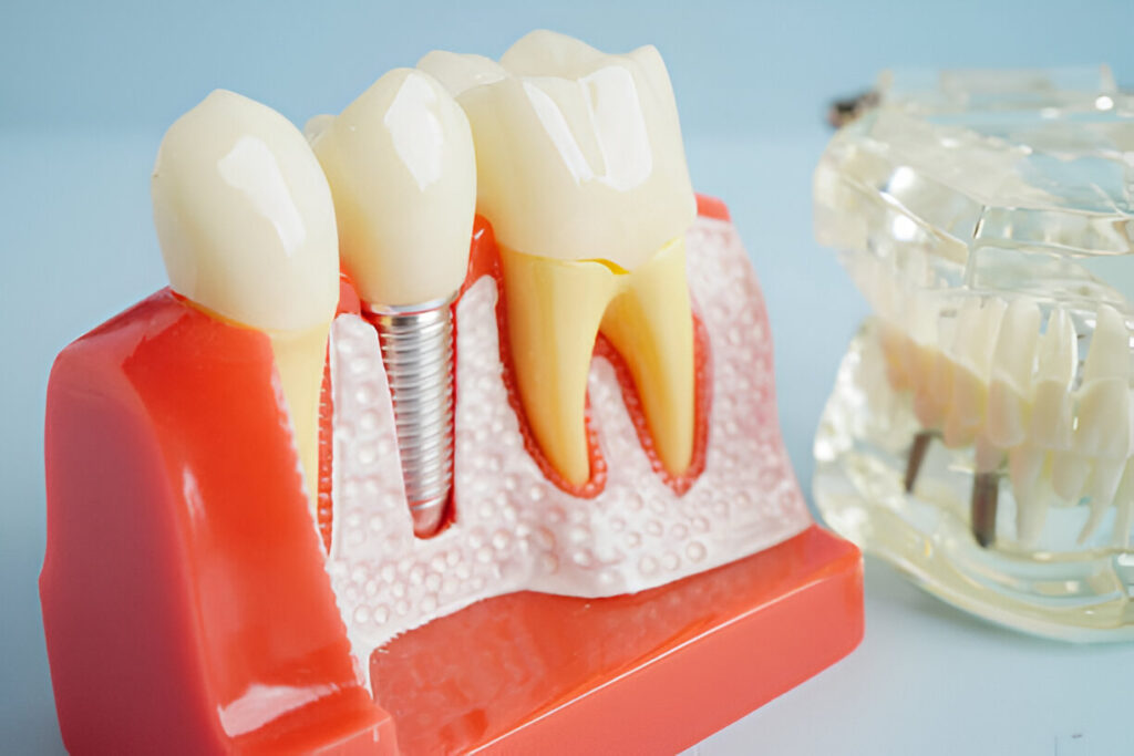 Dental Implants