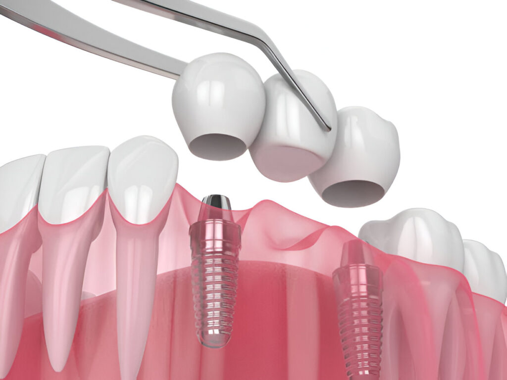 Dental Implants