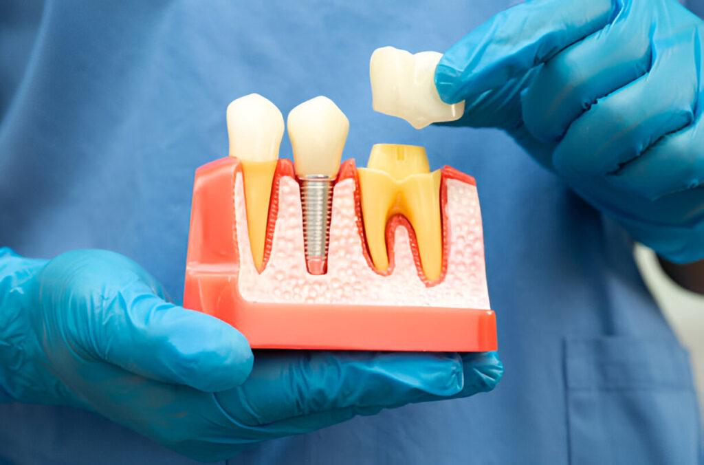 dental implants