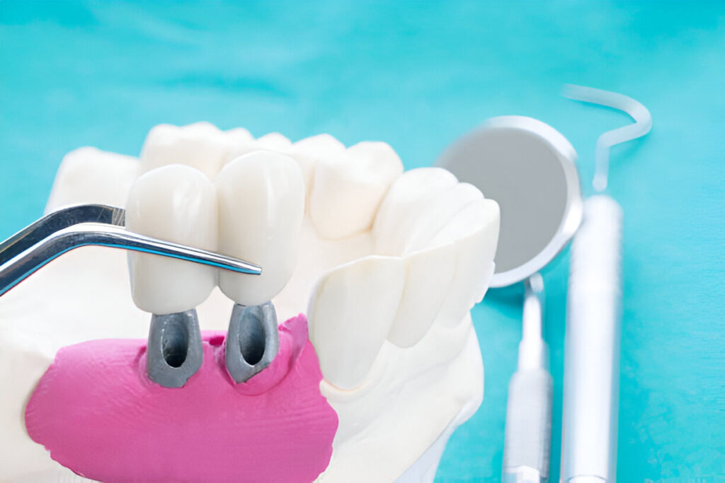 dental implants