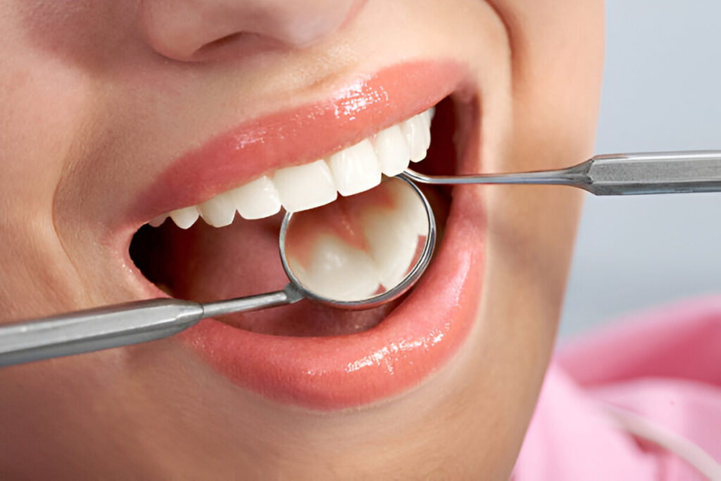 Dental Filling