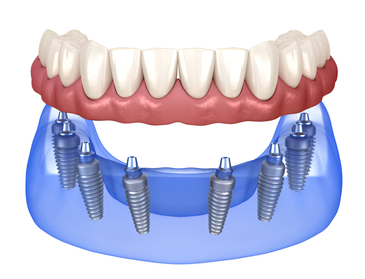 dental implant