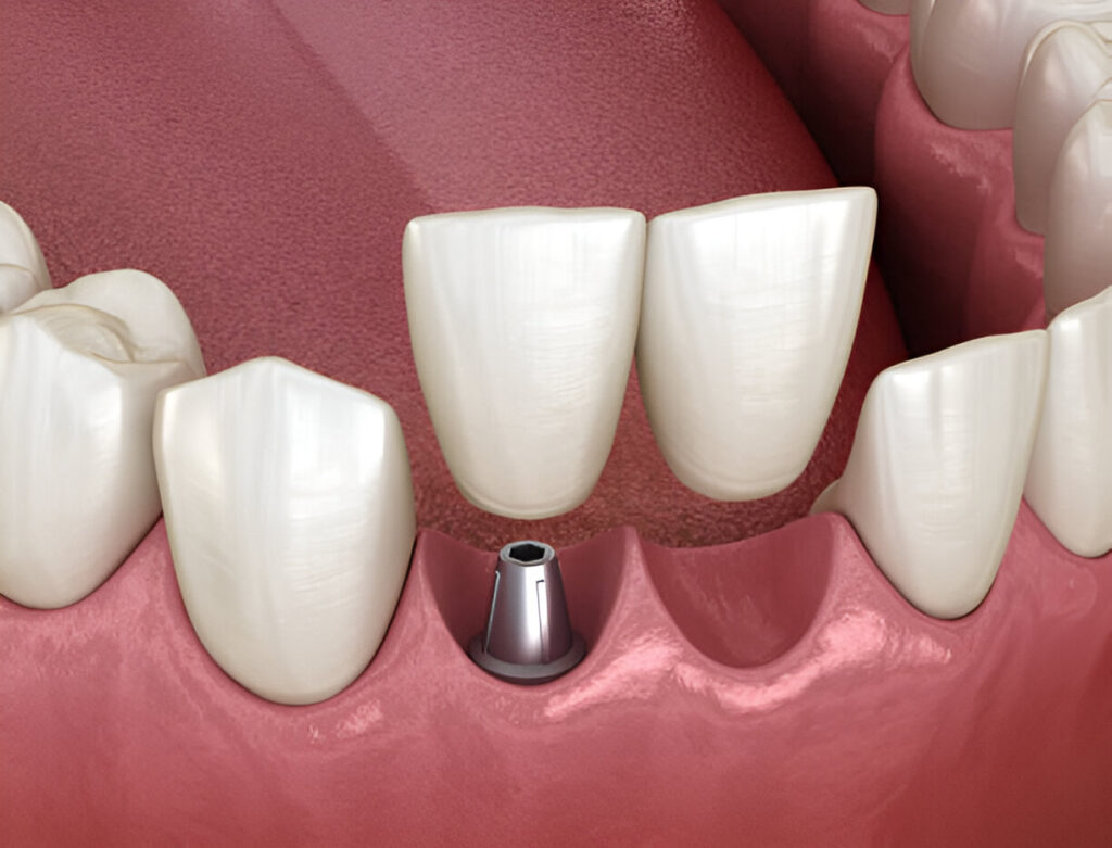 Dental Implants