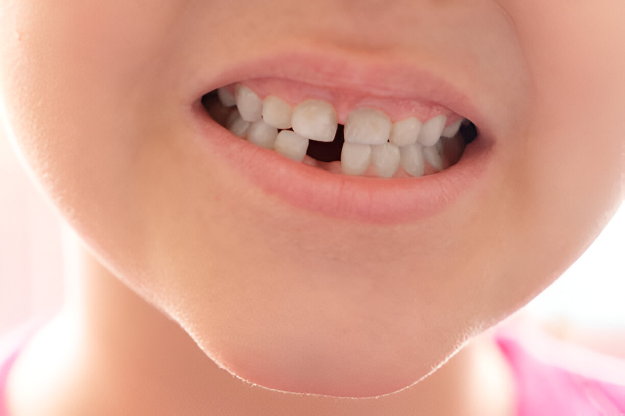 Replace Missing Teeth