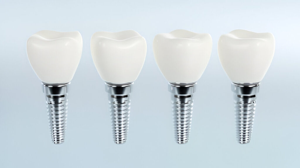 Dental Implant