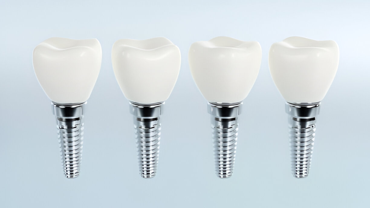 Dental Implant