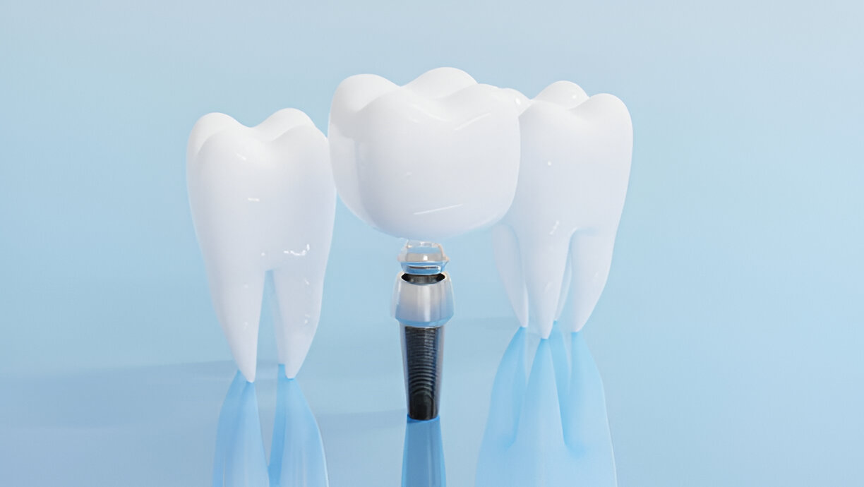 Dental Implants