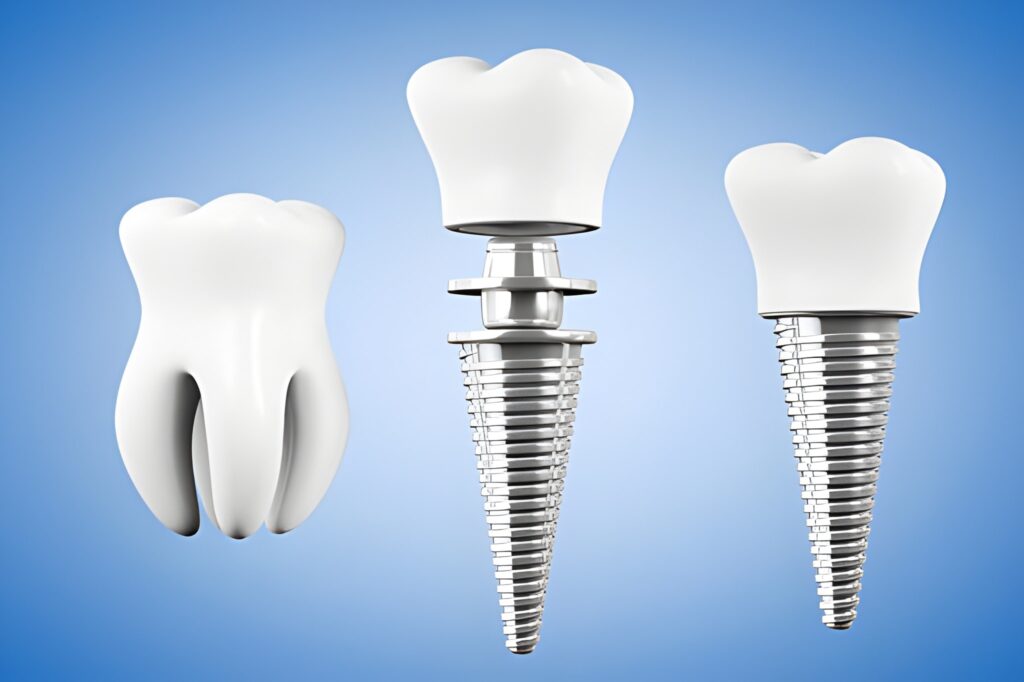 DENTAL IMPLANTS