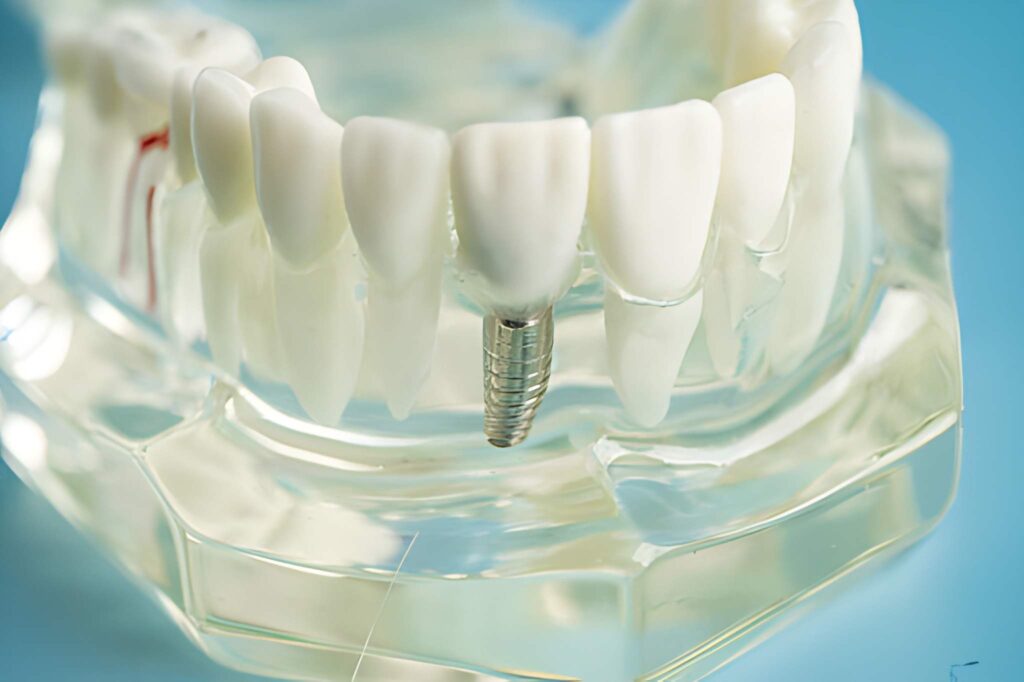Dental Implant