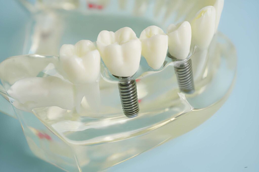 Dental Implants in Aberdeen
