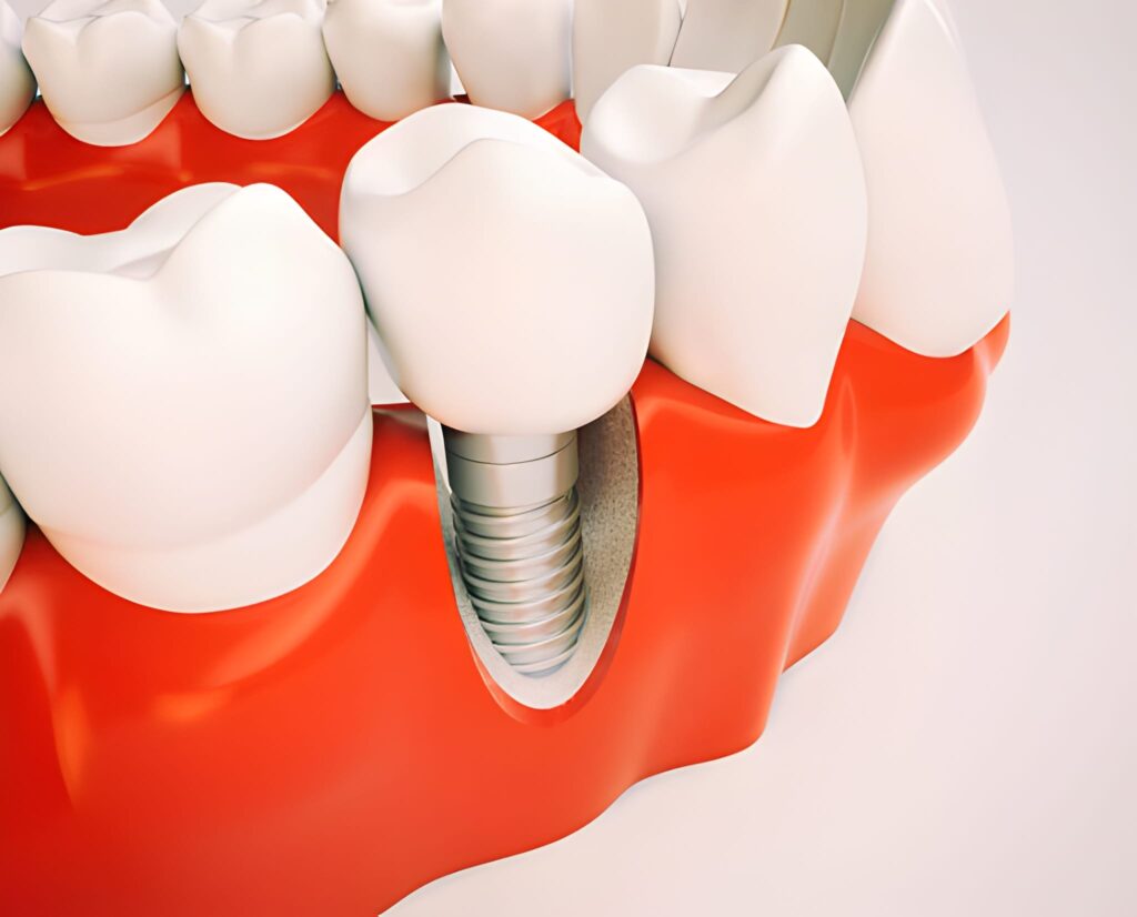 Dental Implants in Aberdeen