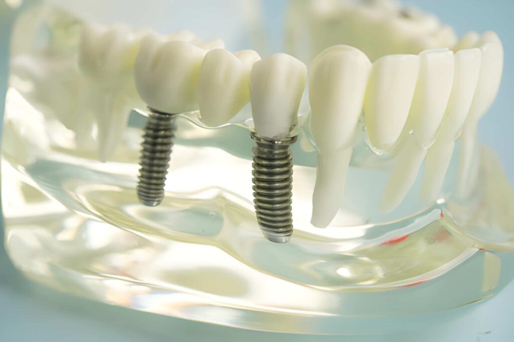 Dental Implants in Aberdeen