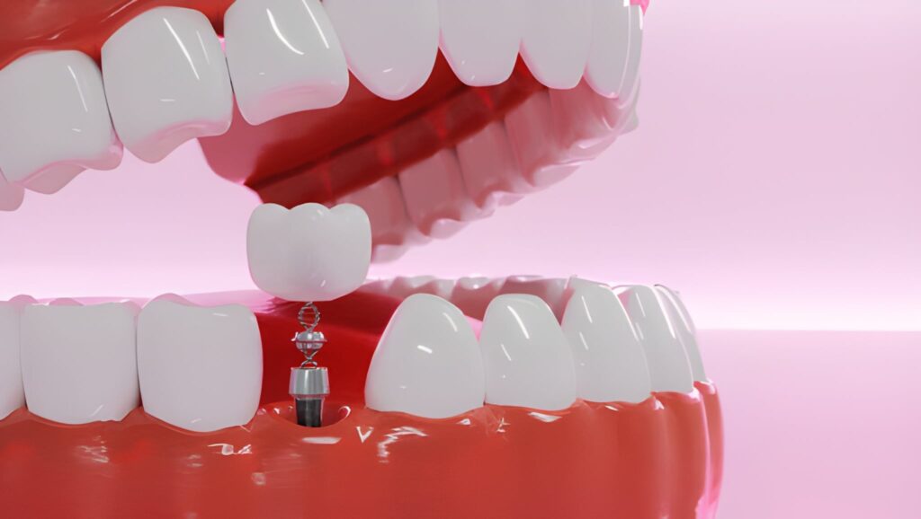 Dental implants
