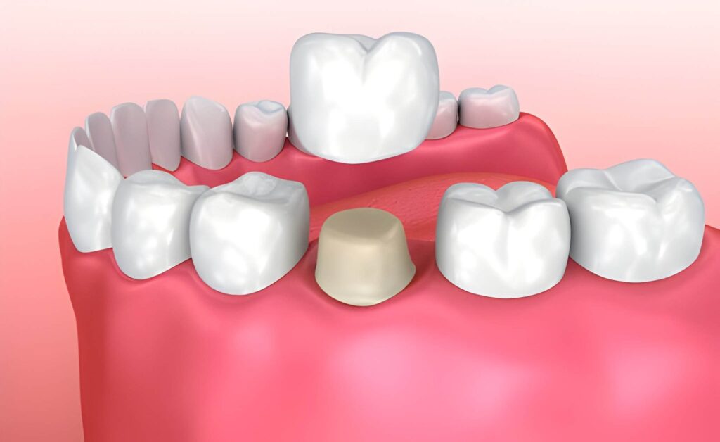 Dental Crown