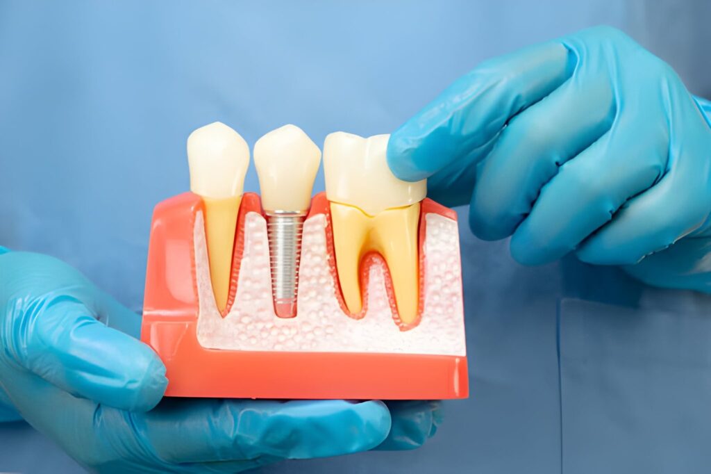 Dental implants