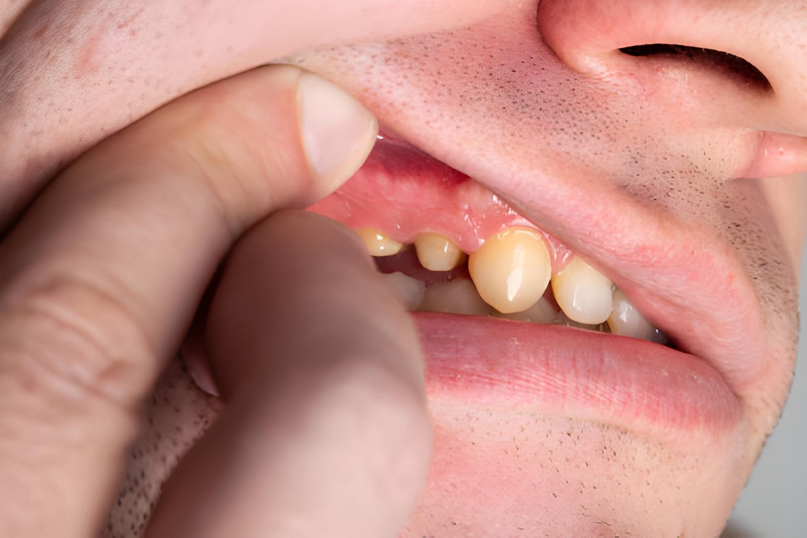 Can Your Body Fight Off a Tooth Infection by Itself?