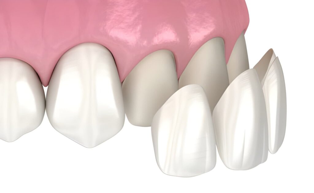 Composite Bonding and Veneers