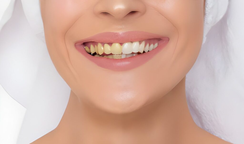 smile makeover