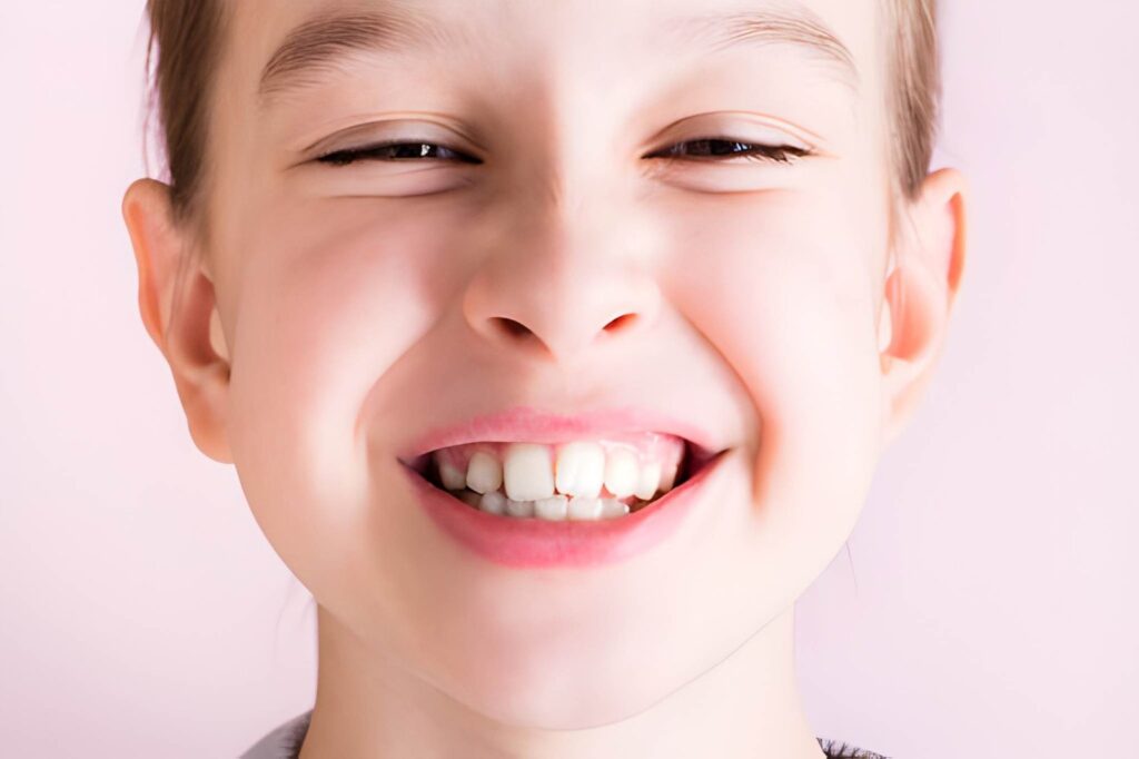 Teeth Crowding