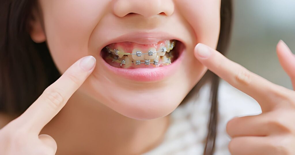 Invisalign Aberdeen